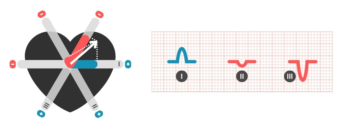 EKG, bipolarni odvodi ekstremiteta