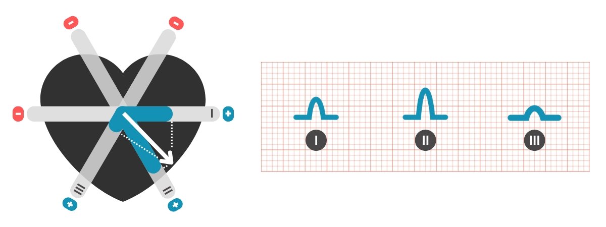 EKG, bipolarni odvodi ekstremiteta