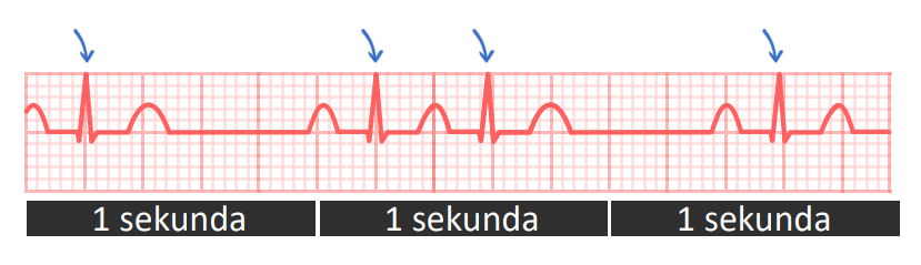 ekg: Određivanje frekvence kod nepravilnog ritma