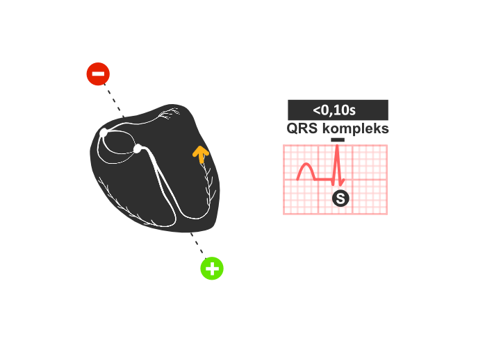 ekg: depolarizacija komora, QRS kompleks