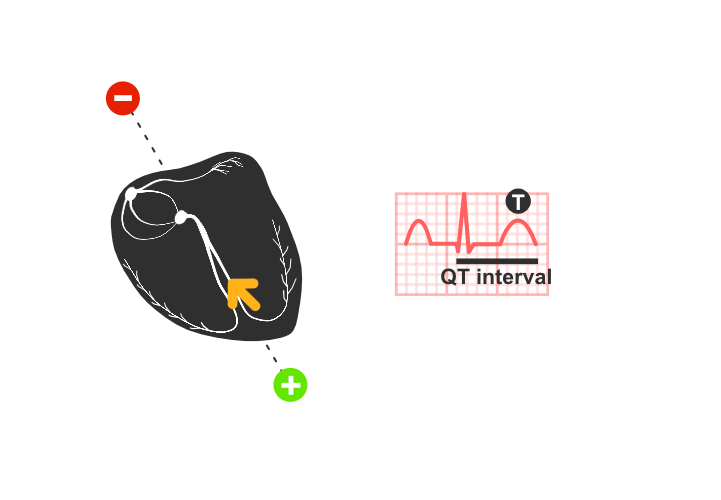 ekg: repolarizacija komora