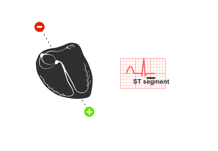 ekg: ST segment