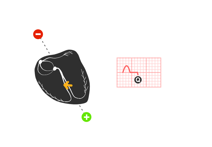 ekg: Depolarizacija septuma i Q talas
