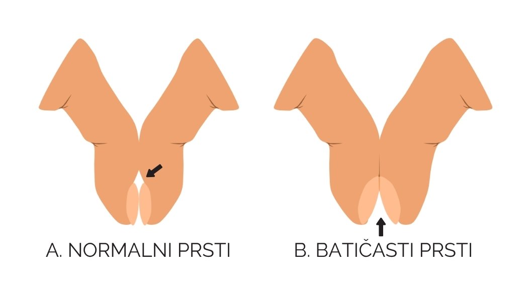 Šamrotov znak - batičasti prsti